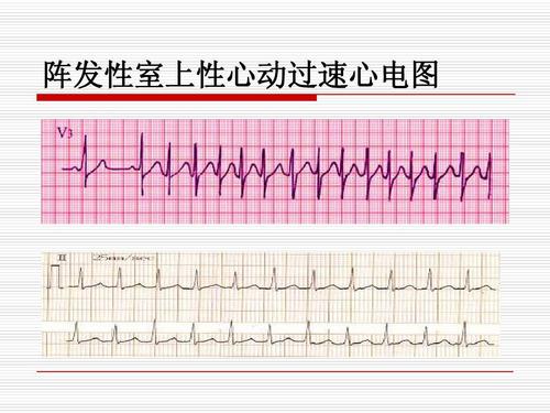 阵发性心房扑动吃什么药_心室扑动室性心动过速_阵发性室上性心动过扑