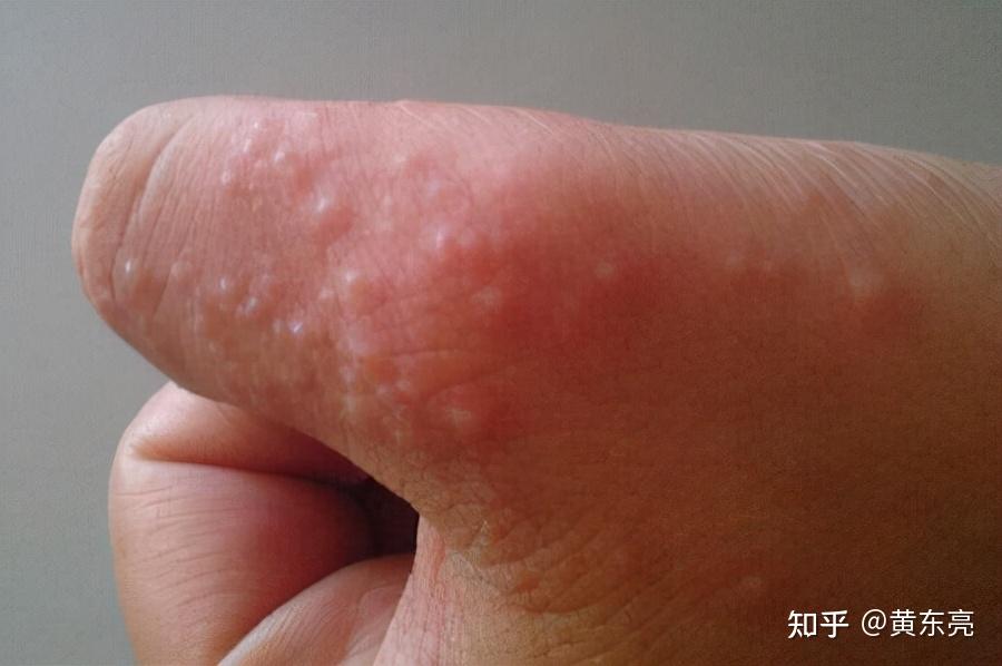 男生出手汗是什么原因_男生出手汗是不是肾虚_男的出手汗是怎么回事